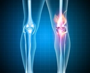 Burning knee, painful knee and normal knee joint, abstract design. Human legs on a blue checkered background.